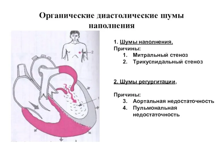 Органические диастолические шумы наполнения 1. Шумы наполнения, Причины: Митральный стеноз