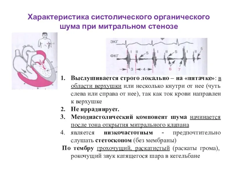 Характеристика систолического органического шума при митральном стенозе Выслушивается строго локально