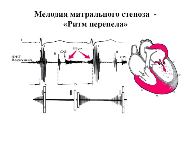 Мелодия митрального стеноза - «Ритм перепела»