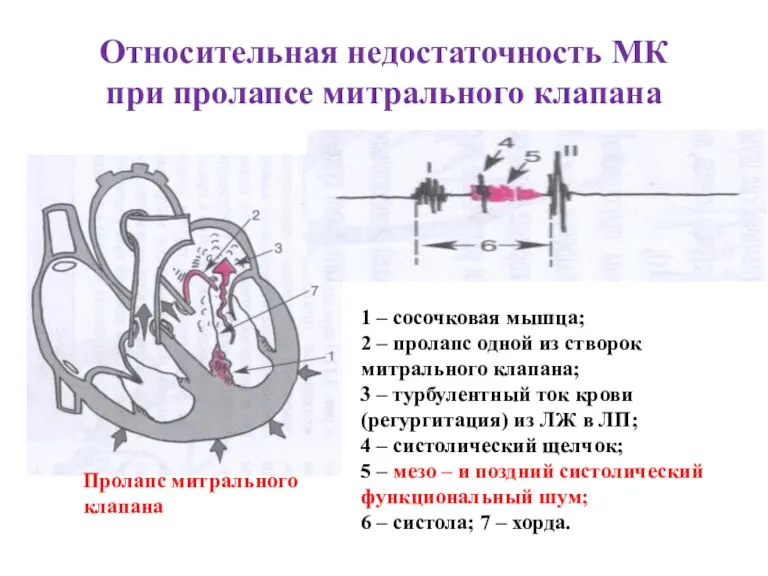 Относительная недостаточность МК при пролапсе митрального клапана 1 – сосочковая