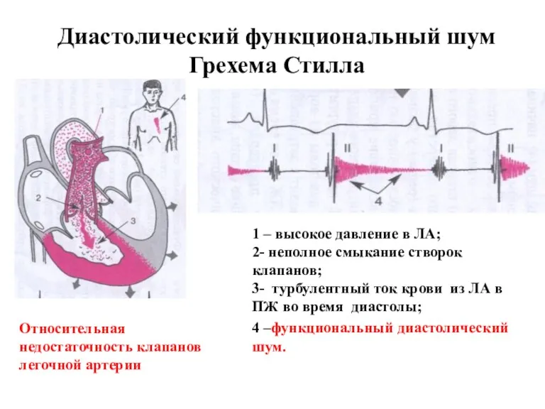 Диастолический функциональный шум Грехема Стилла Относительная недостаточность клапанов легочной артерии