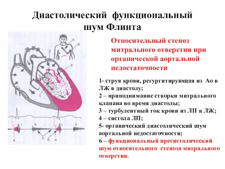 Диастолический функциональный шум Флинта Относительный стеноз митрального отверстия при органической