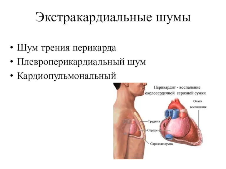 Экстракардиальные шумы Шум трения перикарда Плевроперикардиальный шум Кардиопульмональный