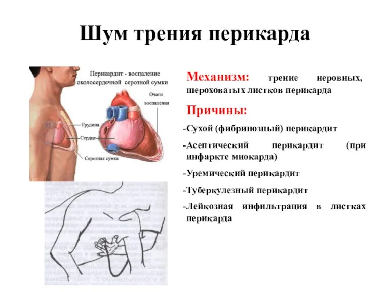 Шум трения перикарда Механизм: трение неровных, шероховатых листков перикарда Причины: