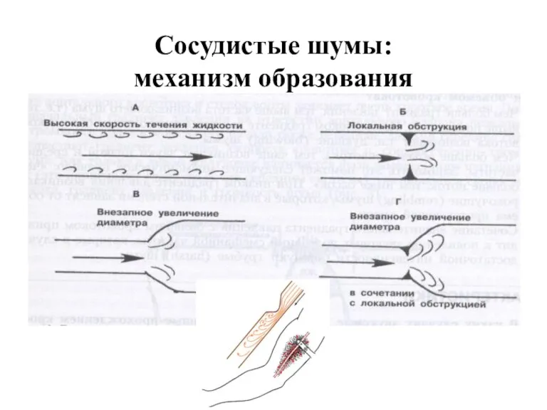 Сосудистые шумы: механизм образования