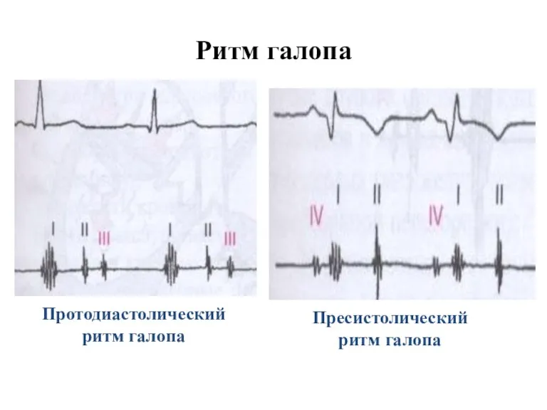 Ритм галопа Протодиастолический ритм галопа Пресистолический ритм галопа