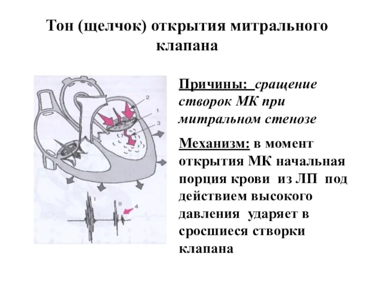 Тон (щелчок) открытия митрального клапана Причины: сращение створок МК при