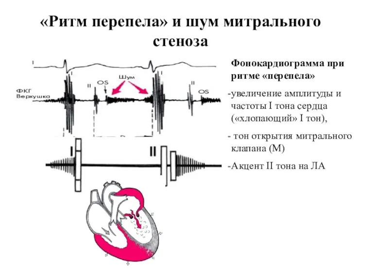 Фонокардиограмма при ритме «перепела» увеличение амплитуды и частоты I тона