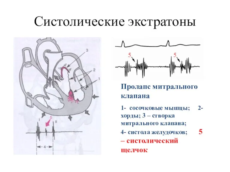 Систолические экстратоны Пролапс митрального клапана 1- сосочковые мышцы; 2- хорды;