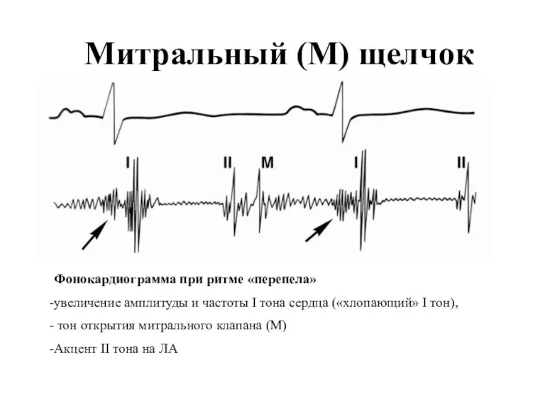 Митральный (М) щелчок Фонокардиограмма при ритме «перепела» увеличение амплитуды и