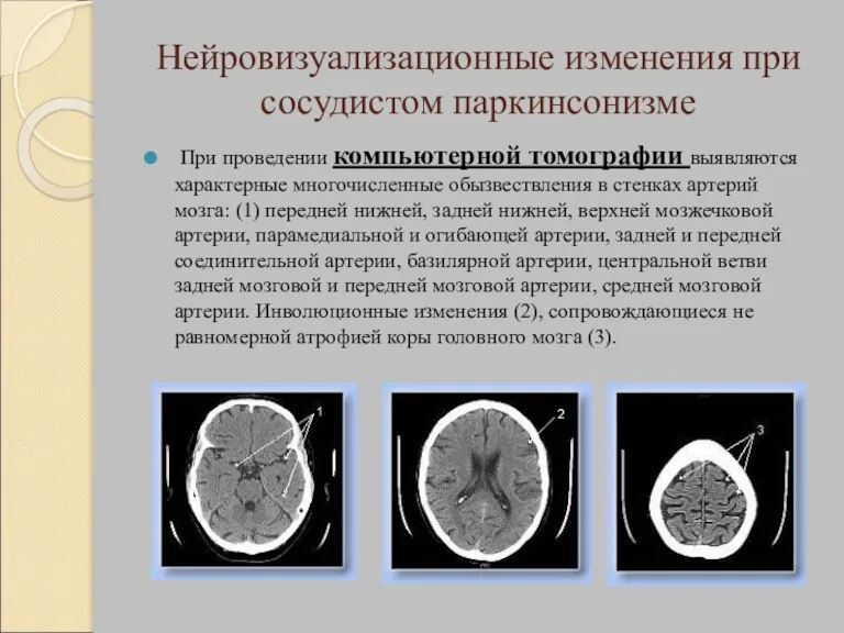 Нейровизуализационные изменения при сосудистом паркинсонизме При проведении компьютерной томографии выявляются