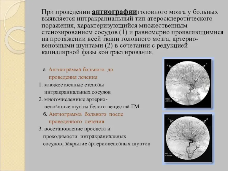 При проведении ангиографии головного мозга у больных выявляется интракраниальный тип