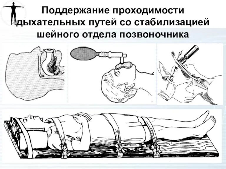 Поддержание проходимости дыхательных путей со стабилизацией шейного отдела позвоночника