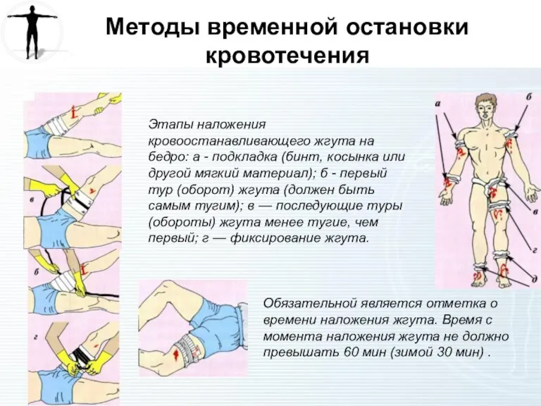 Методы временной остановки кровотечения Этапы наложения кровоостанавливающего жгута на бедро: