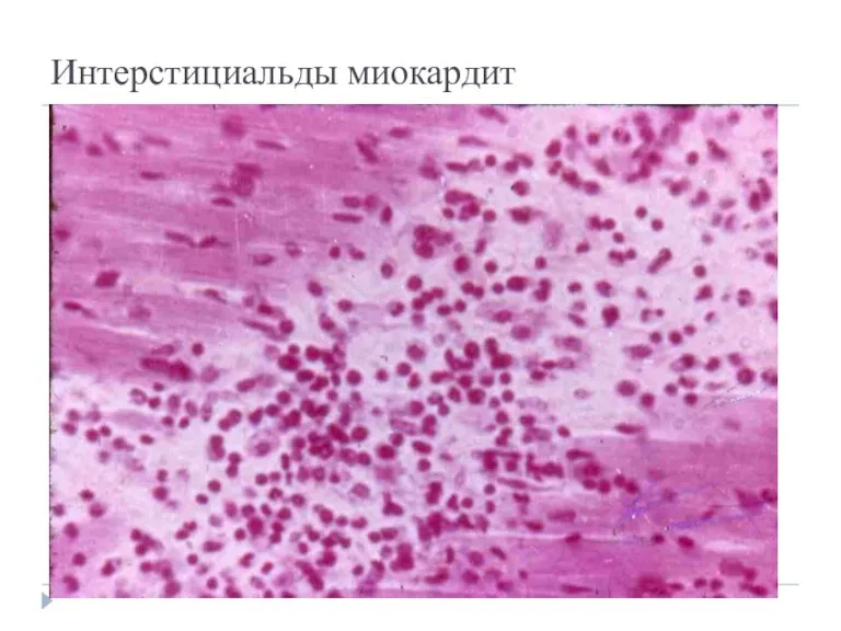 Интерстициальды миокардит