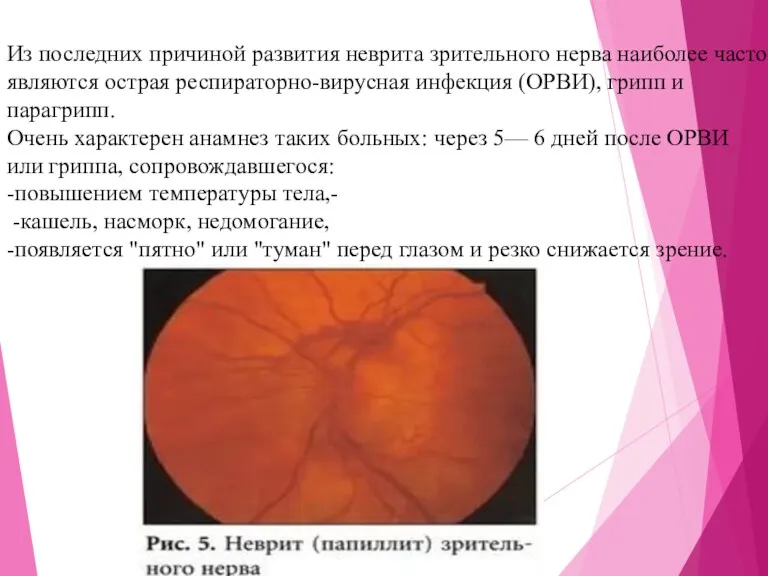 Из последних причиной развития неврита зрительного нерва наиболее часто являются