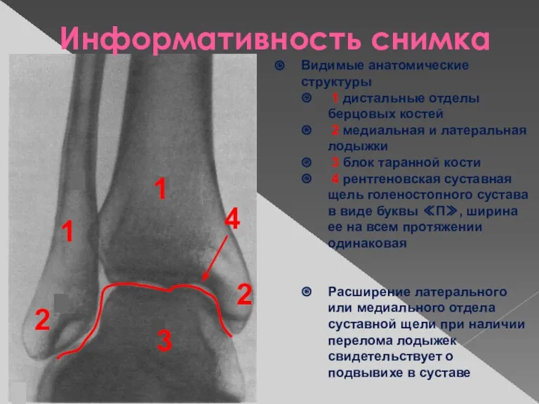 Видимые анатомические структуры 1 дистальные отделы берцовых костей 2 медиальная