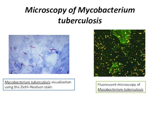 Microscopy of Mycobacterium tuberculosis Mycobacterium tuberculosis visualization using the Ziehl–Neelsen stain. Fluorescent microscopy of Mycobacterium tuberculosis