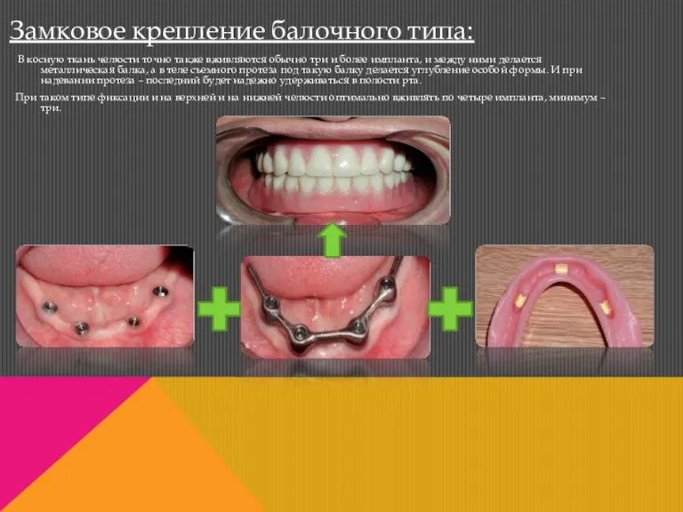В косную ткань челюсти точно также вживляются обычно три и