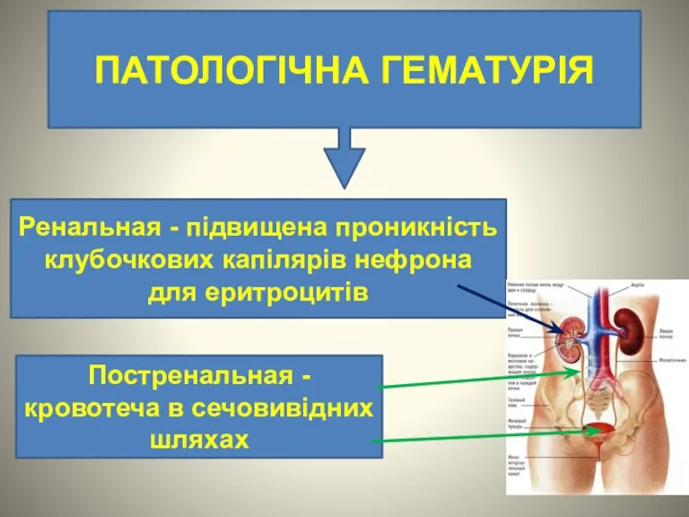 ПАТОЛОГІЧНА ГЕМАТУРІЯ Ренальная - підвищена проникність клубочкових капілярів нефрона для