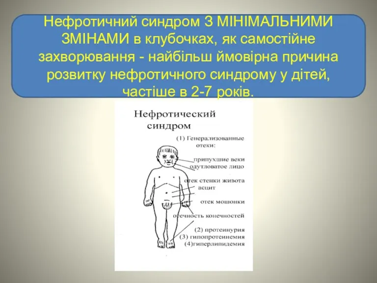 Нефротичний синдром З МІНІМАЛЬНИМИ ЗМІНАМИ в клубочках, як самостійне захворювання