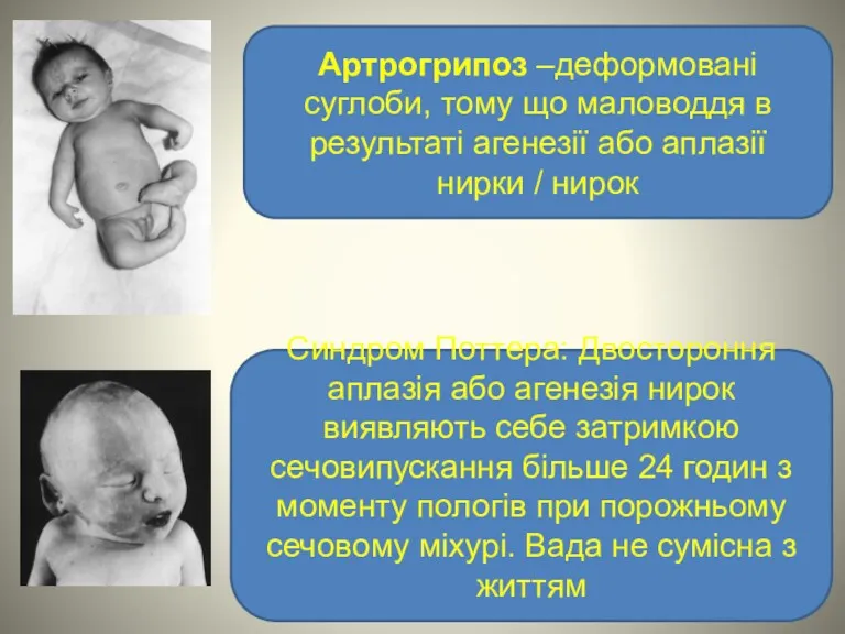 Артрогрипоз –деформовані суглоби, тому що маловоддя в результаті агенезії або