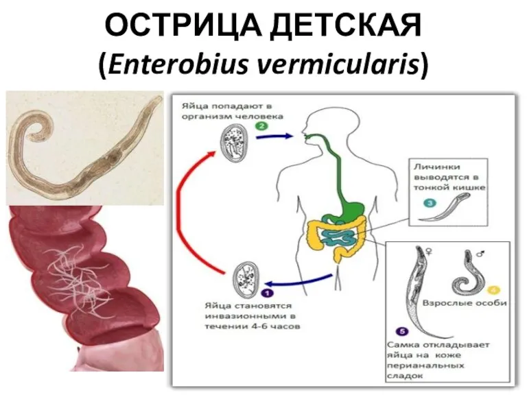 ОСТРИЦА ДЕТСКАЯ (Enterobius vermicularis)