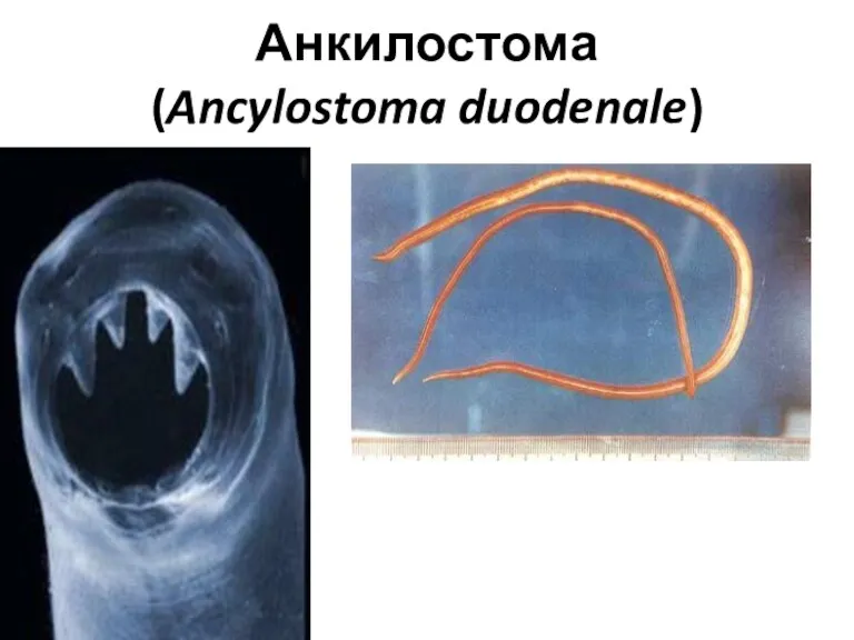 Анкилостома (Ancylostoma duodenale)