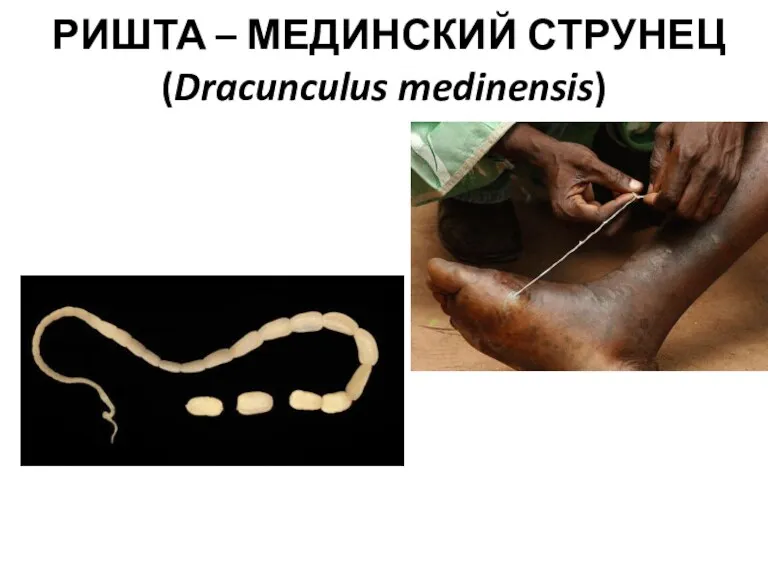 РИШТА – МЕДИНСКИЙ СТРУНЕЦ (Dracunculus medinensis)