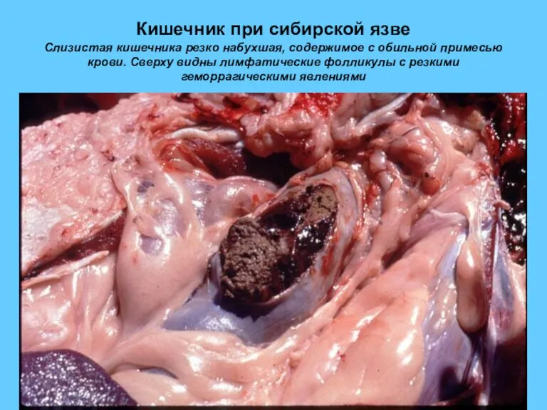Кишечник при сибирской язве Слизистая кишечника резко набухшая, содержимое с обильной примесью крови.