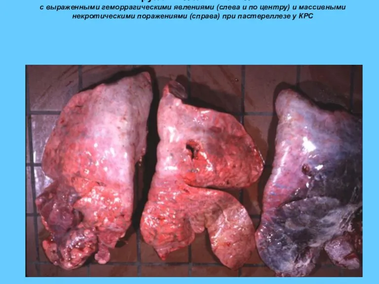 Крупозная пневмония с выраженными геморрагическими явлениями (слева и по центру) и массивными некротическими
