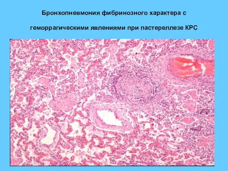 Бронхопневмония фибринозного характера с геморрагическими явлениями при пастереллезе КРС