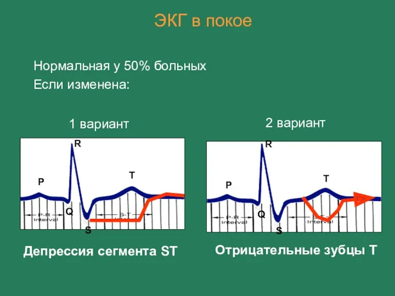 ЭКГ в покое Нормальная у 50% больных Если изменена: P