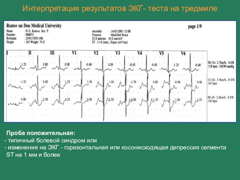 Интерпретация результатов ЭКГ- теста на тредмиле Проба положительная: типичный болевой