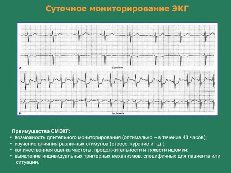 Суточное мониторирование ЭКГ Преимущества СМЭКГ: возможность длительного мониторирования (оптимально –