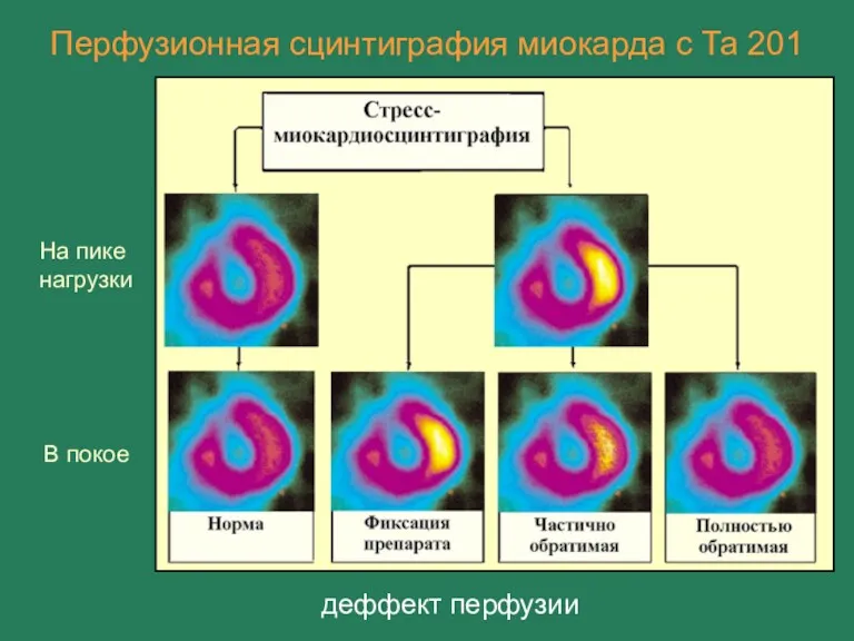 Перфузионная сцинтиграфия миокарда с Та 201 В покое На пике нагрузки деффект перфузии