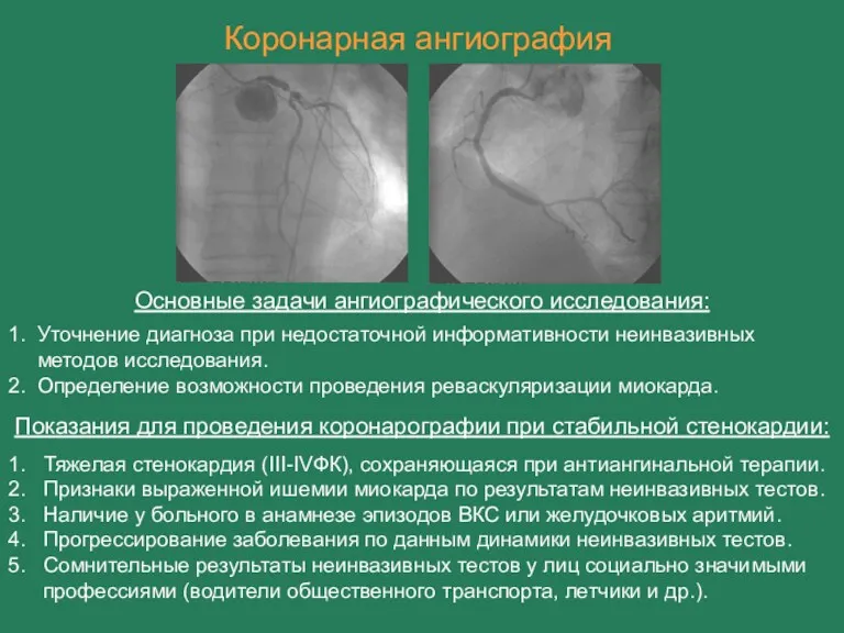 Коронарная ангиография Основные задачи ангиографического исследования: 1. Тяжелая стенокардия (III-IVФК),