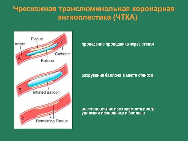 Чрескожная транслюминальная коронарная ангиопластика (ЧТКА) проведение проводника через стеноз раздувание