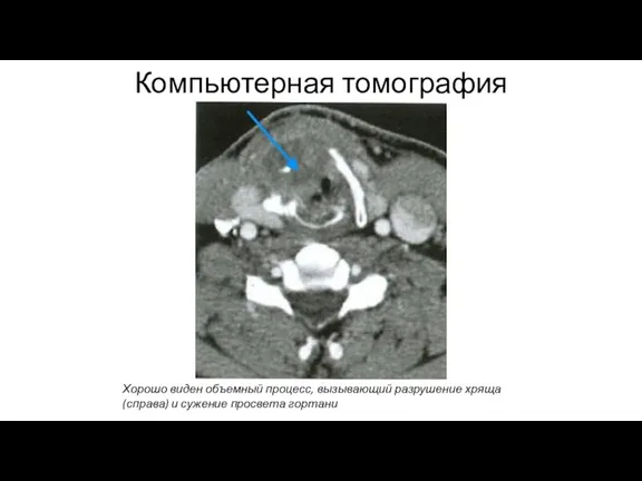 Компьютерная томография Хорошо виден объемный процесс, вызывающий разрушение хряща (справа) и сужение просвета гортани