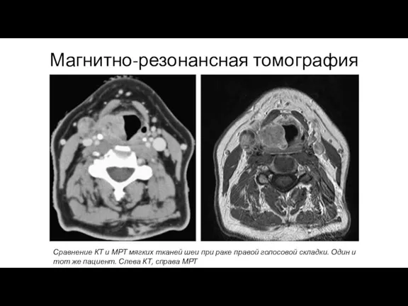 Магнитно-резонансная томография Сравнение КТ и МРТ мягких тканей шеи при раке правой голосовой