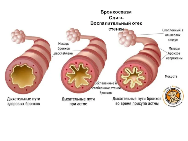 Бронхоспазм Слизь Воспалительный отек стенки