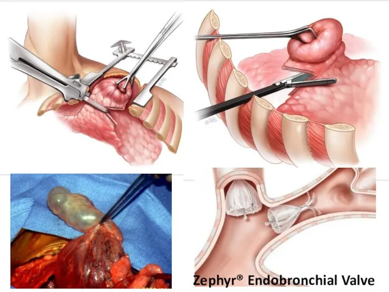 Zephyr® Endobronchial Valve