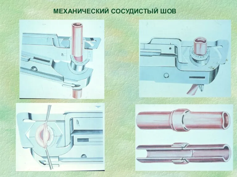 МЕХАНИЧЕСКИЙ СОСУДИСТЫЙ ШОВ