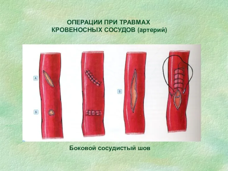 ОПЕРАЦИИ ПРИ ТРАВМАХ КРОВЕНОСНЫХ СОСУДОВ (артерий) Боковой сосудистый шов