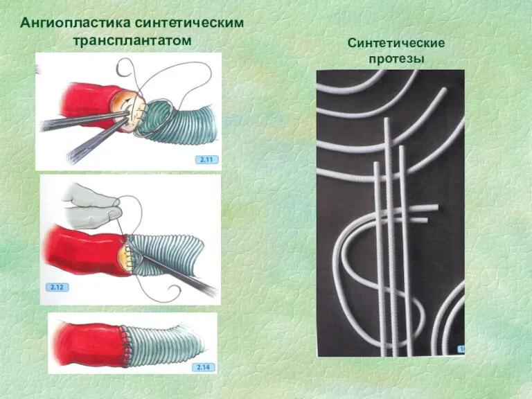 Ангиопластика синтетическим трансплантатом Синтетические протезы