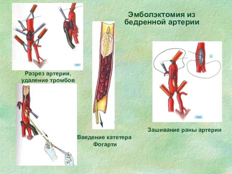 Эмболэктомия из бедренной артерии Разрез артерии, удаление тромбов Введение катетера Фогарти Зашивание раны артерии
