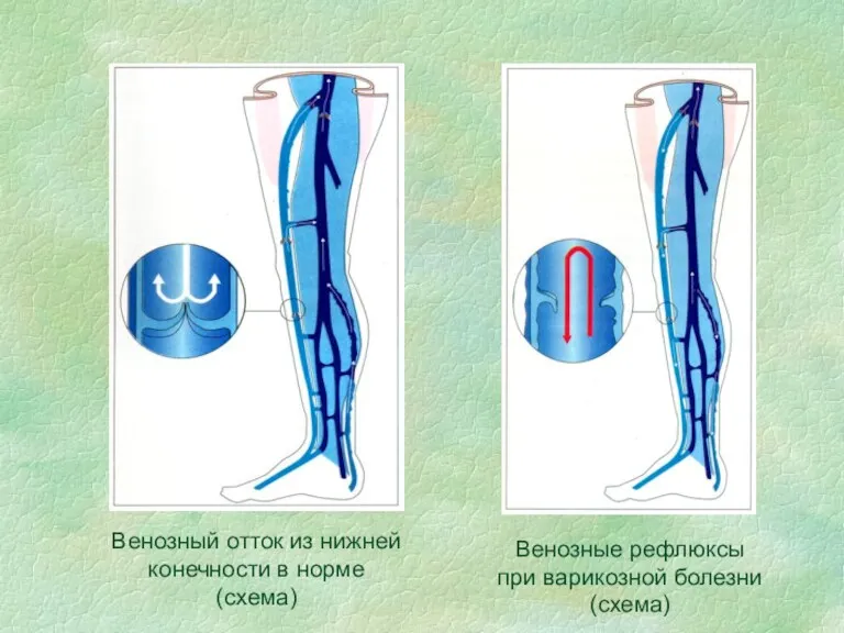 Венозные рефлюксы при варикозной болезни (схема) Венозный отток из нижней конечности в норме (схема)