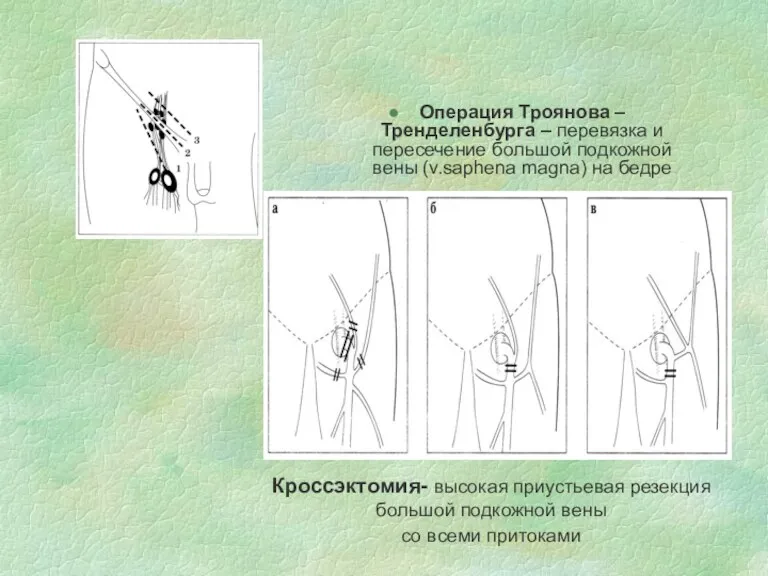 Операция Троянова –Тренделенбурга – перевязка и пересечение большой подкожной вены