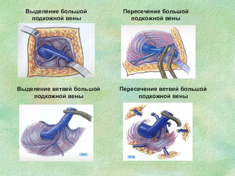 Выделение большой подкожной вены Пересечение большой подкожной вены Выделение ветвей