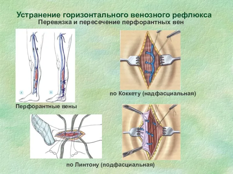 Перевязка и пересечение перфорантных вен по Линтону (подфасциальная) по Коккету